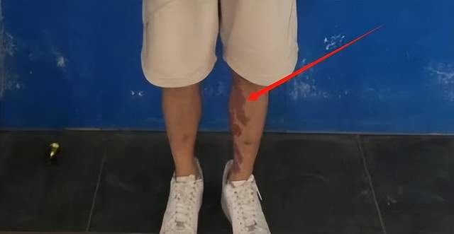 全身照腿部伤痕惊心更多受害家属发声爱游戏ayx营救神速！泰方公布星星(图2)